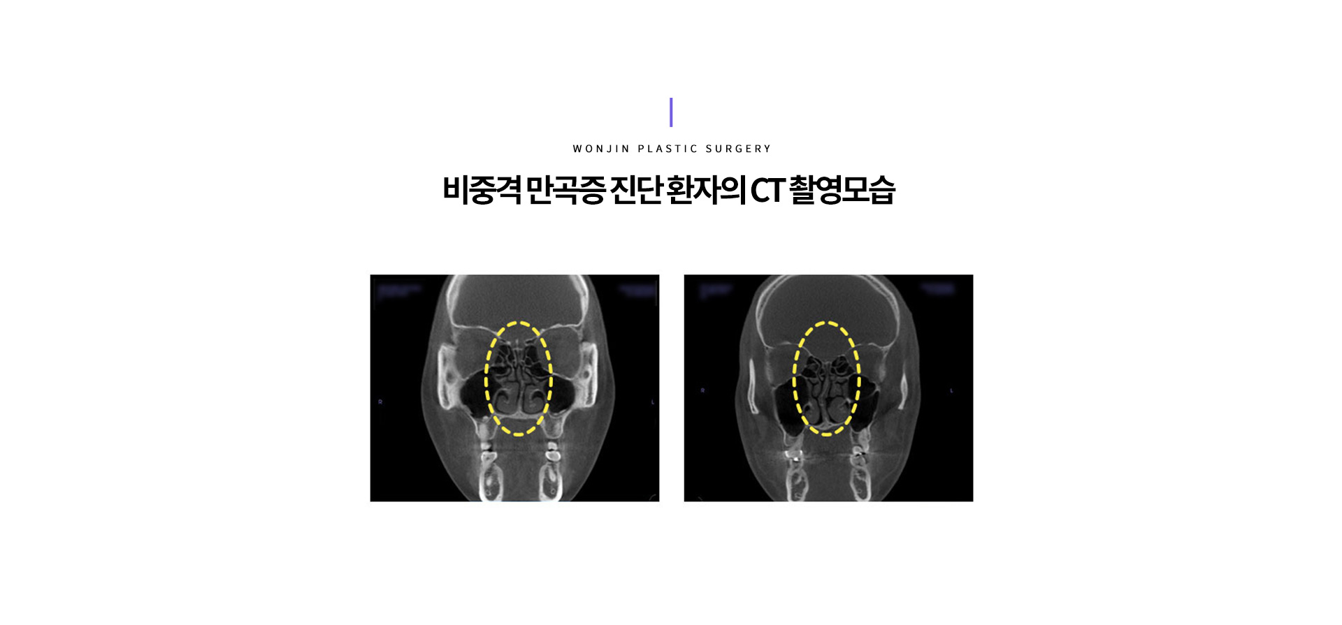 비중격 만곡증 진단 환자의 CT 촬영모습 