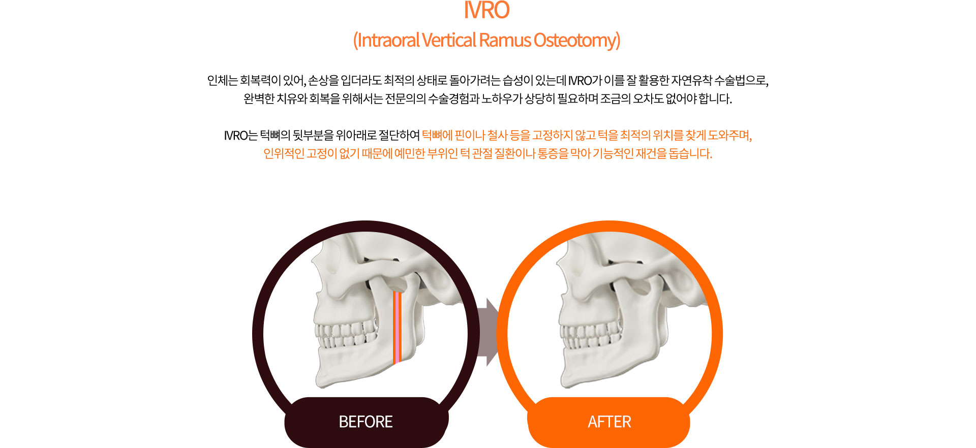 IVRO (Intraoral Vertical Ramus Osteotomy)
		인체는 회복력이 있어, 손상을 입더라도 최적의 상태로 돌아가려는 습성이 있는데 IVRO가 이를 잘 활용한 자연유착 수술법으로,
		완벽한 치유와 회복을 위해서는 전문의의 수술경험과 노하우가 상당히 필요하며 조금의 오차도 없어야 합니다.

		IVRO는 턱뼈의 뒷부분을 위아래로 절단하여 턱뼈에 핀이나 철사 등을 고정하지 않고 턱을 최적의 위치를 찾게 도와주며,
		인위적인 고정이 없기 때문에 예민한 부위인 턱 관절 질환이나 통증을 막아 기능적인 재건을 돕습니다.
		
