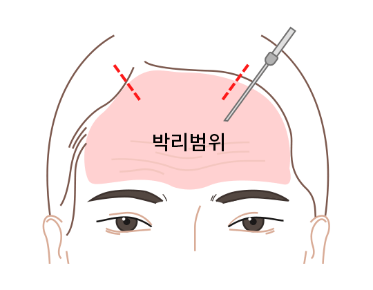 이마와 눈썹 밑부분 분리
