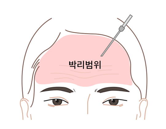 이마와 눈썹 밑부분 분리