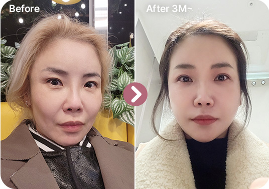 리프팅