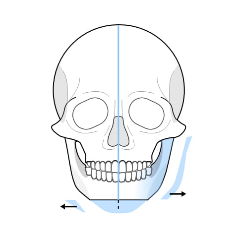 턱이 비대칭인 사각 턱 수술과정 이미지3