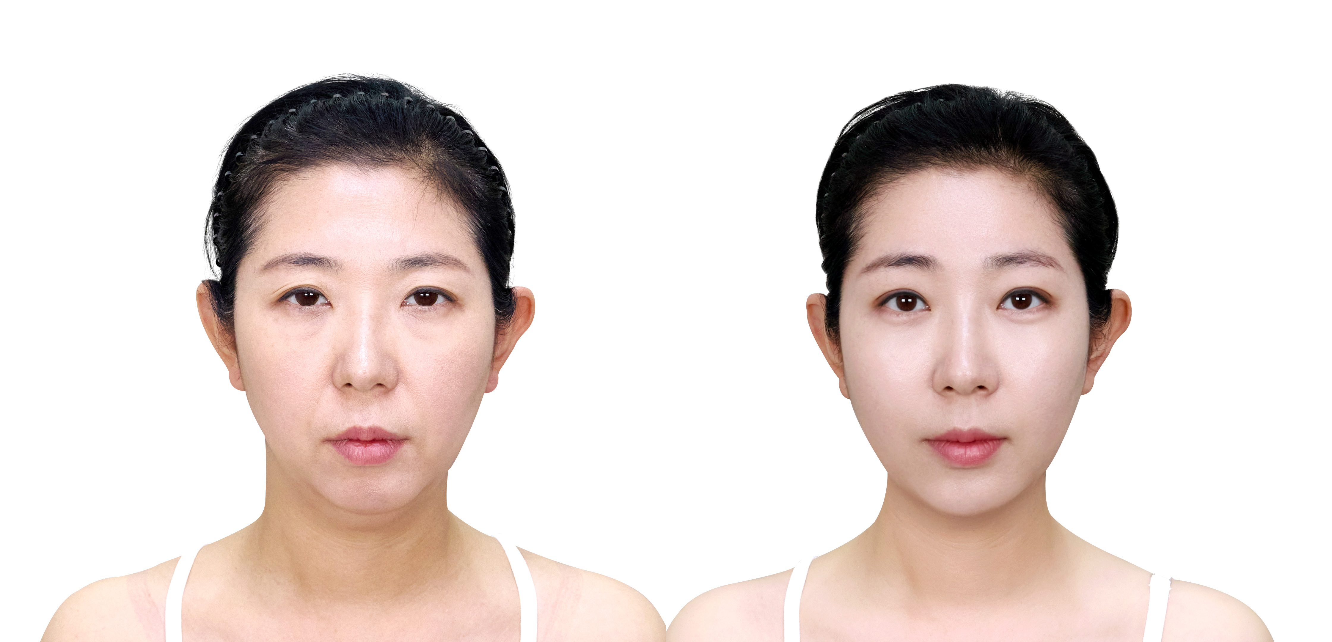 성형 전/후 이미지